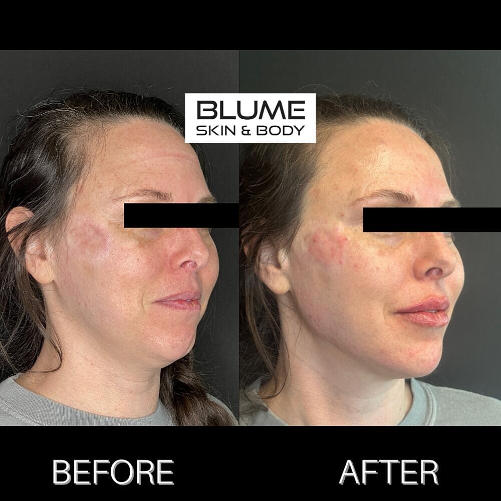 Dermal Fillers Before & After