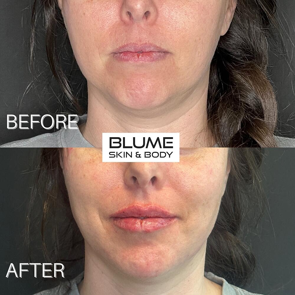 Dermal Fillers Before & After
