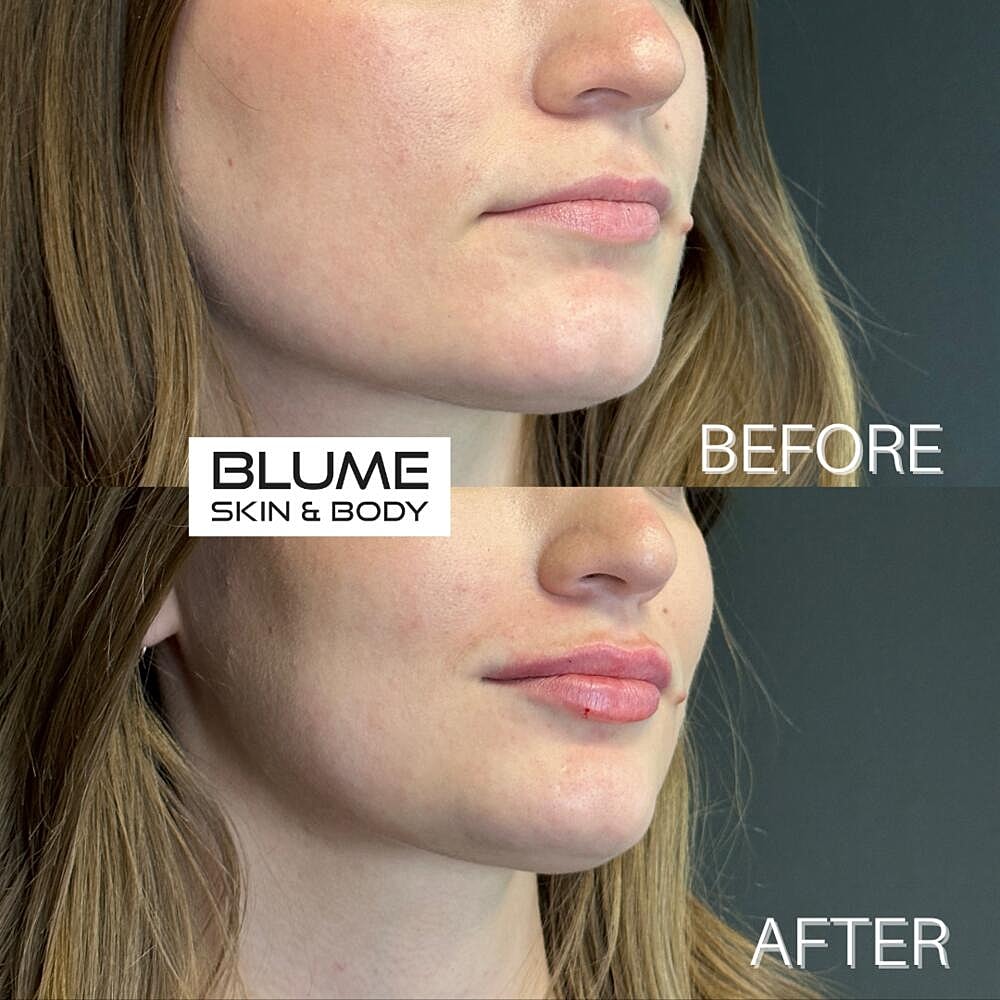Dermal Fillers Before & After