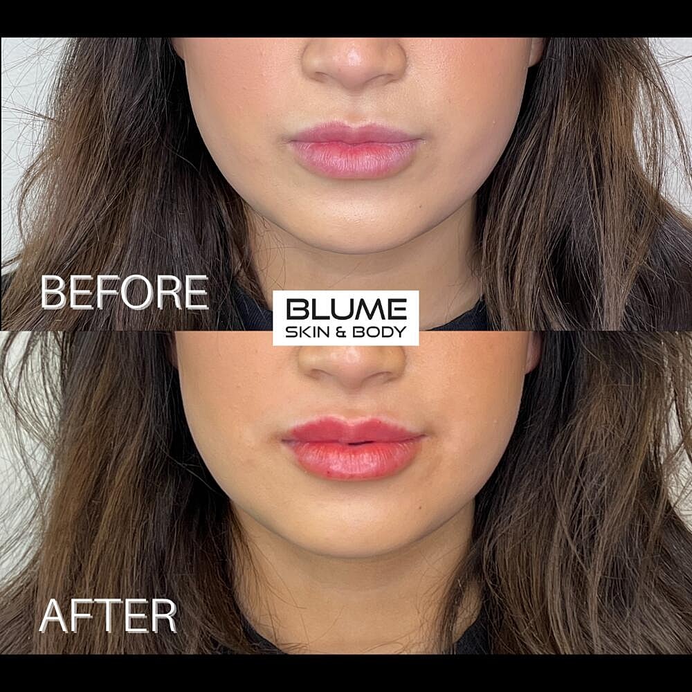 Dermal Fillers Before & After
