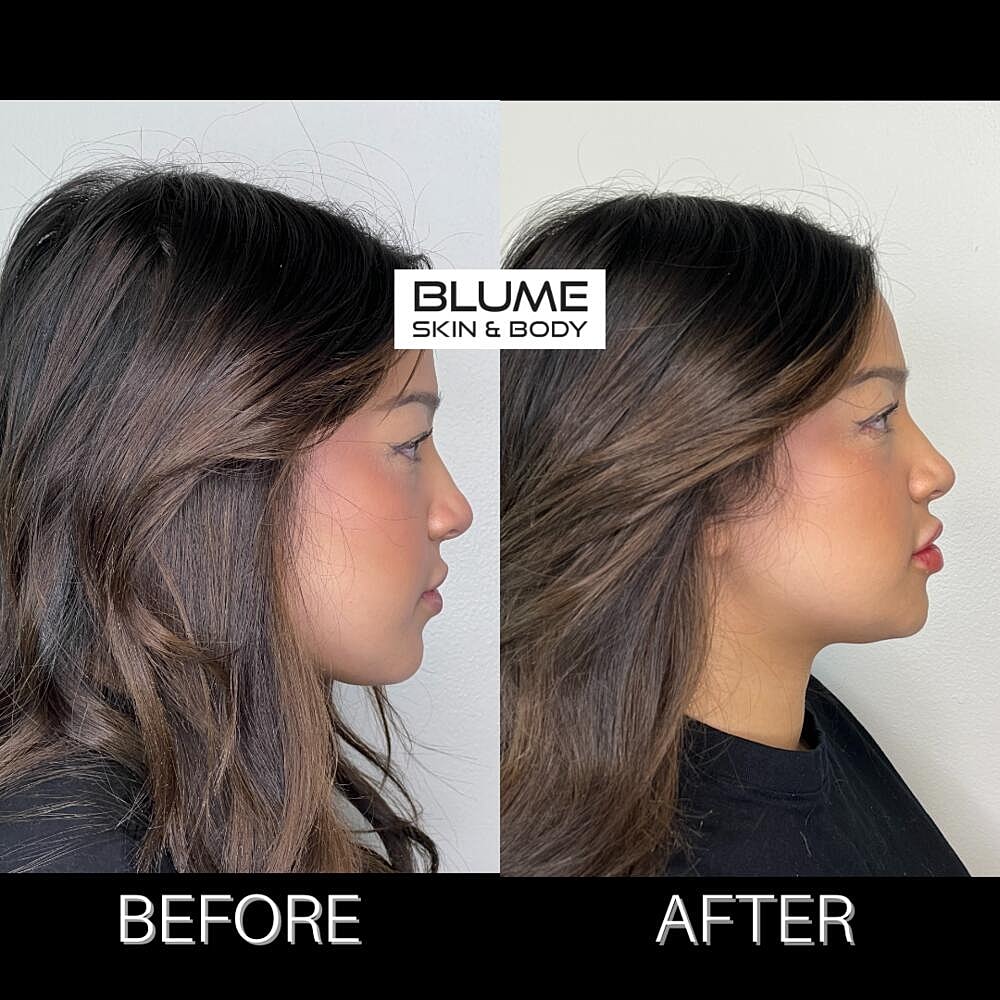 Dermal Fillers Before & After