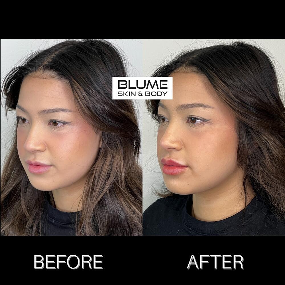 Dermal Fillers Before & After