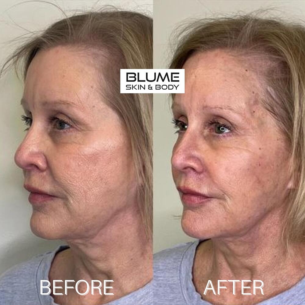 Dermal Fillers Before & After