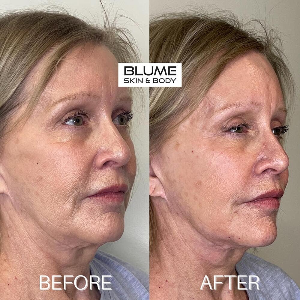 Dermal Fillers Before & After