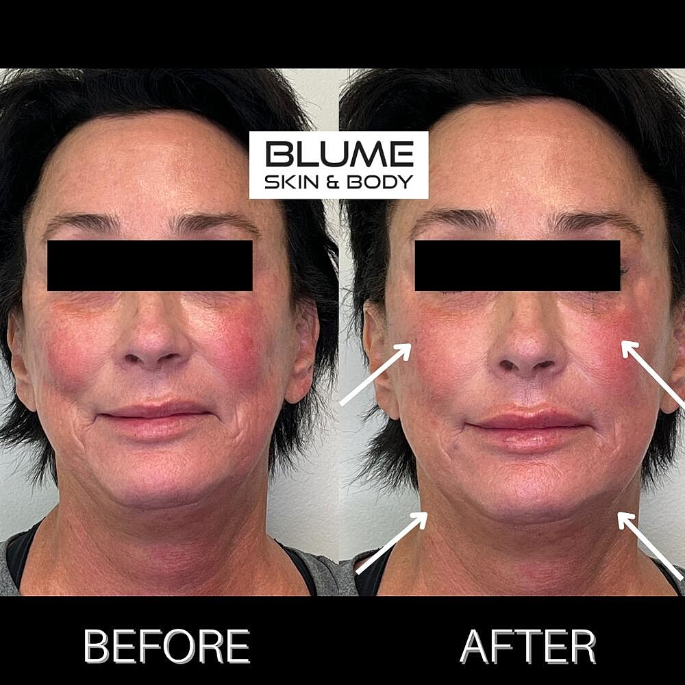 Dermal Fillers Before & After