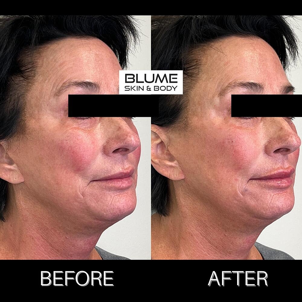 Dermal Fillers Before & After