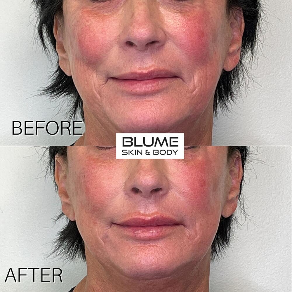 Dermal Fillers Before & After