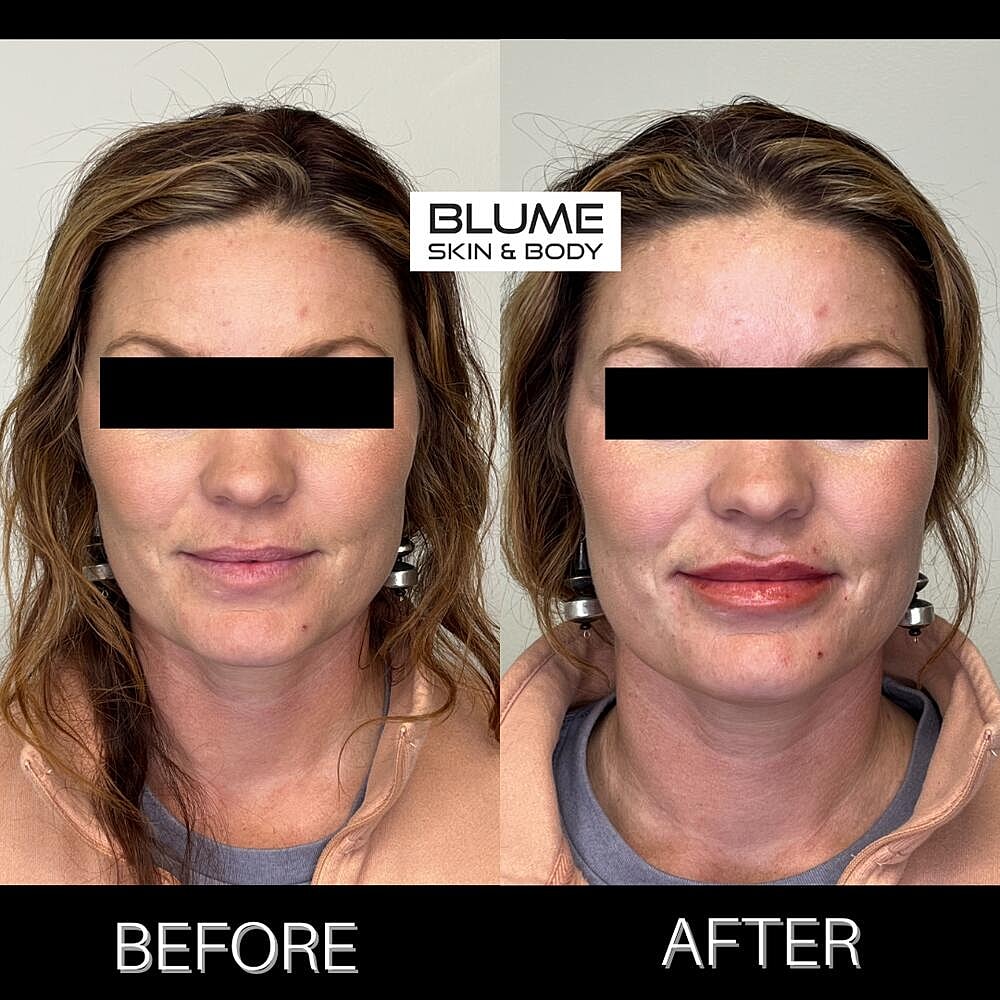 Dermal Fillers Before & After