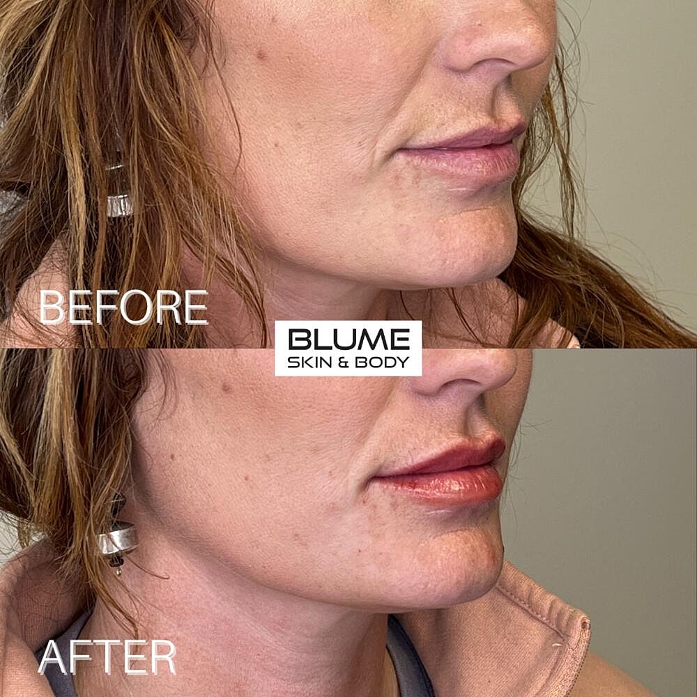 Dermal Fillers Before & After