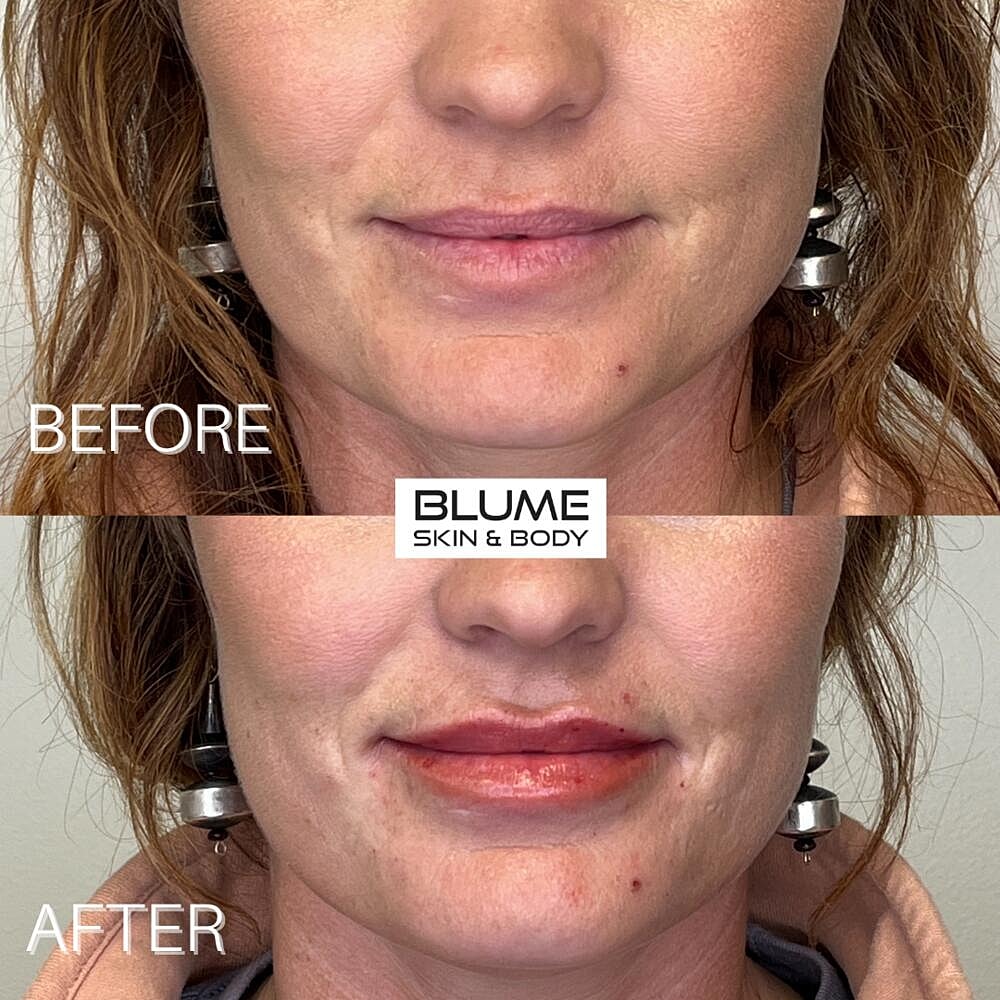 Dermal Fillers Before & After