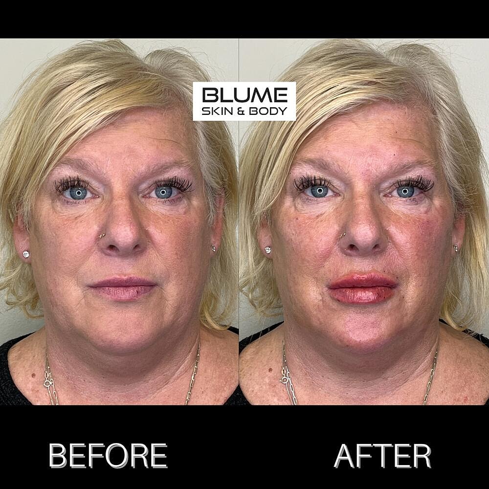 Dermal Fillers Before & After