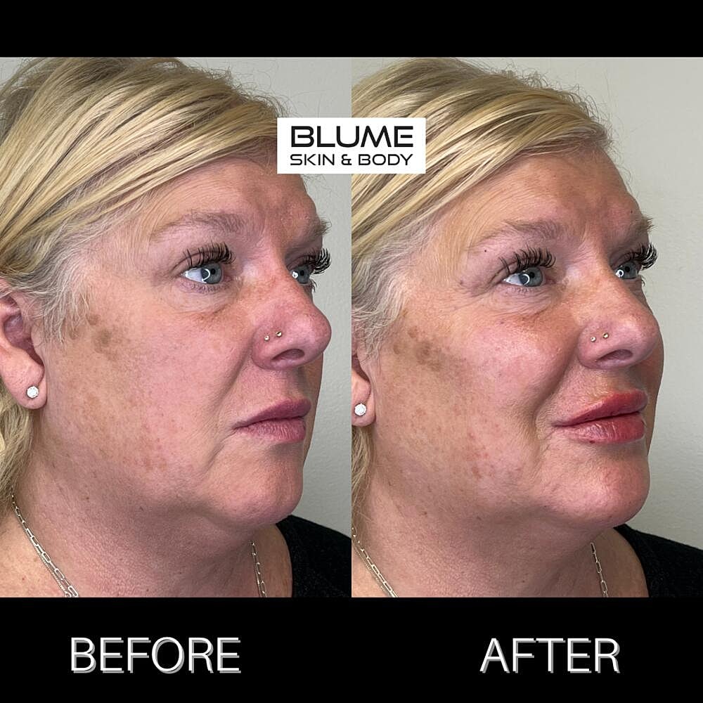 Dermal Fillers Before & After