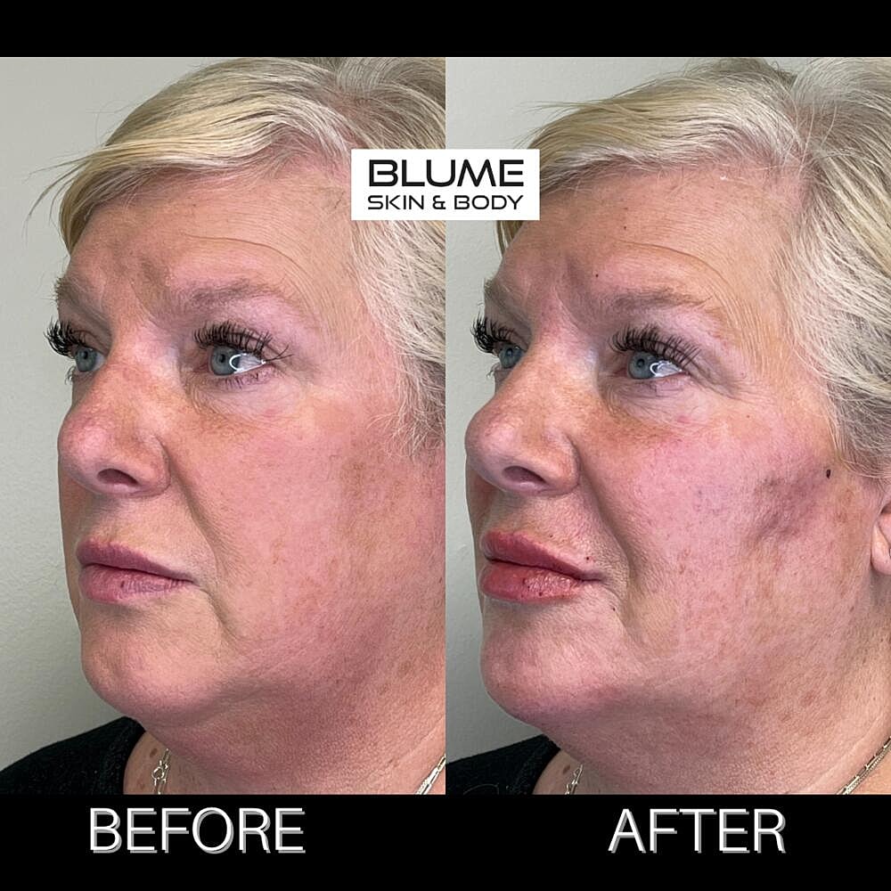 Dermal Fillers Before & After