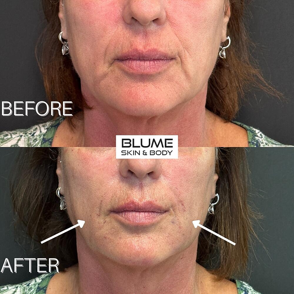 Dermal Fillers Before & After