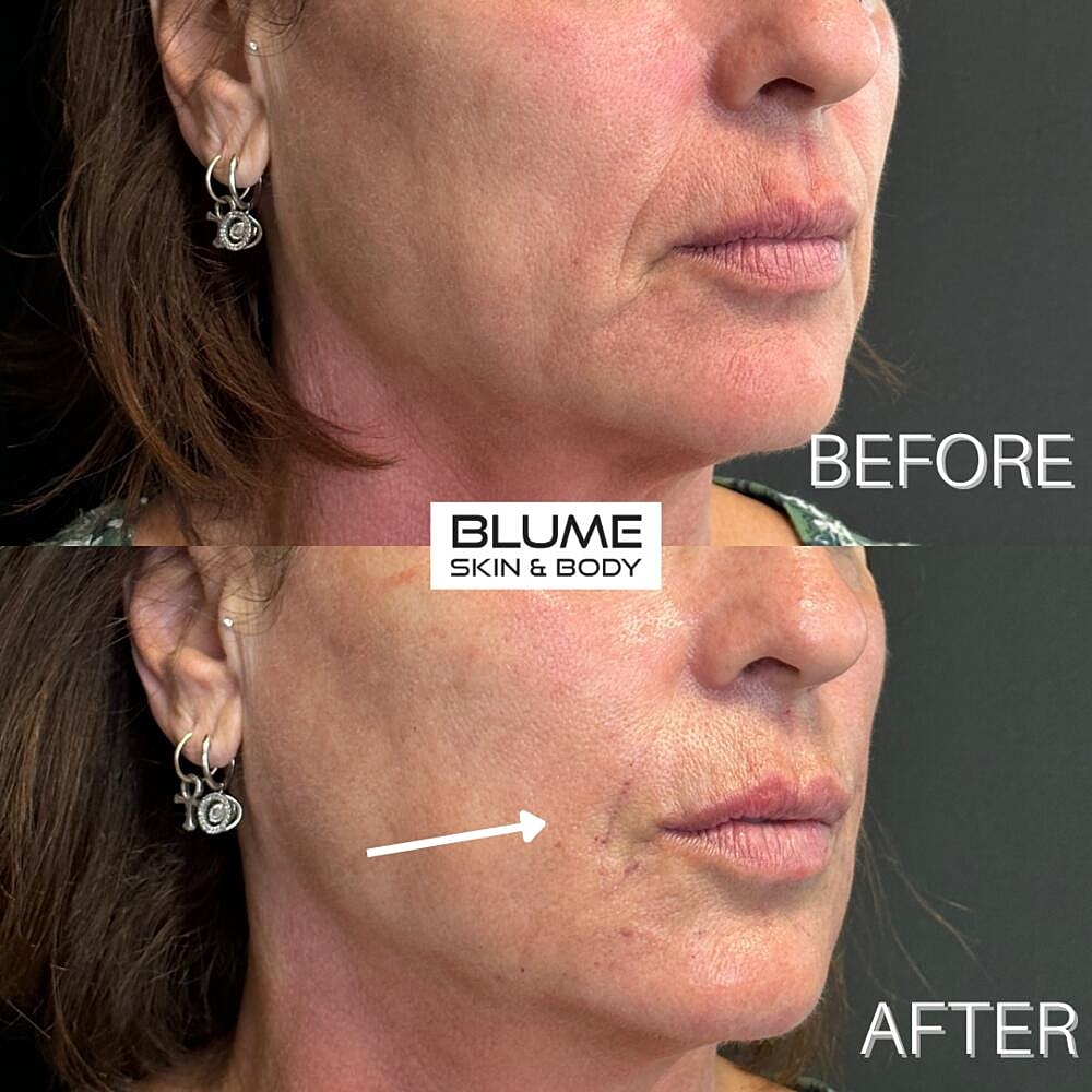 Dermal Fillers Before & After