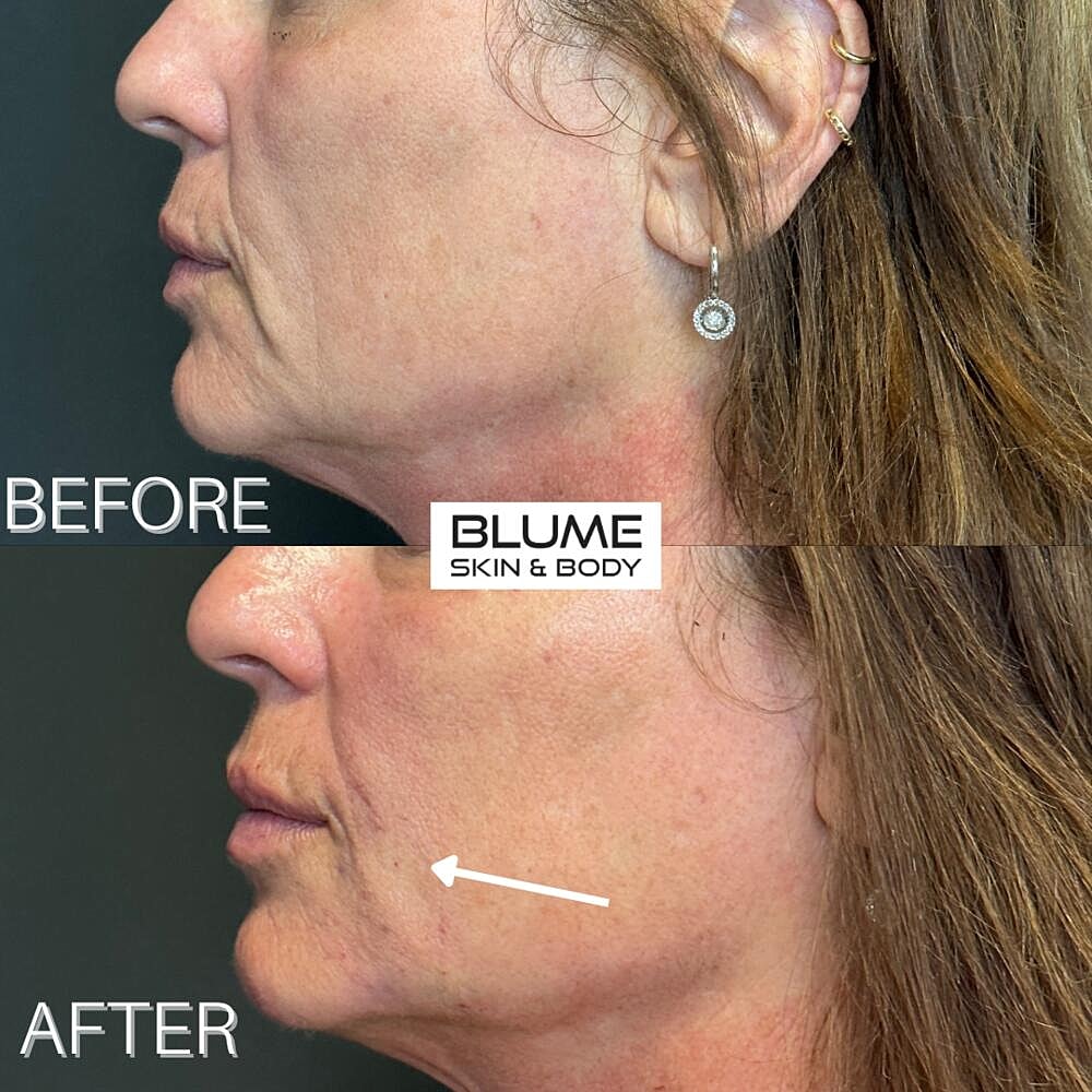 Dermal Fillers Before & After