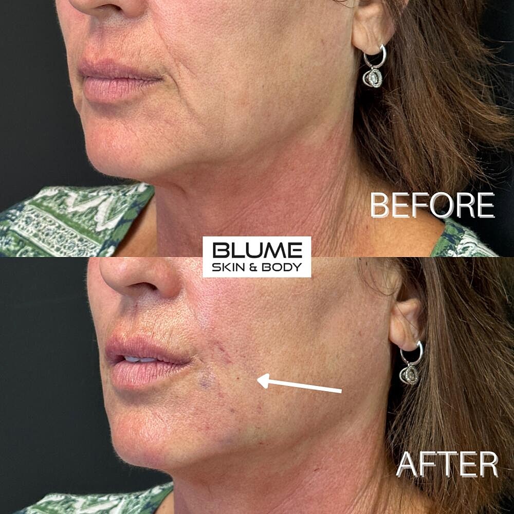 Dermal Fillers Before & After