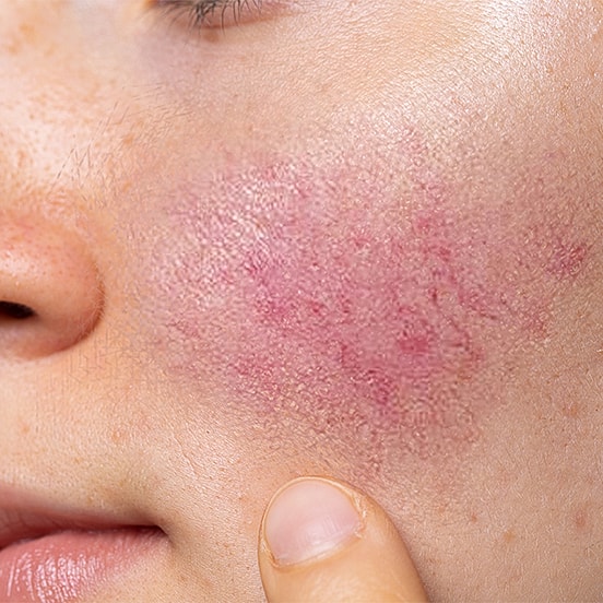 Close-up of skin with redness and irritation.
