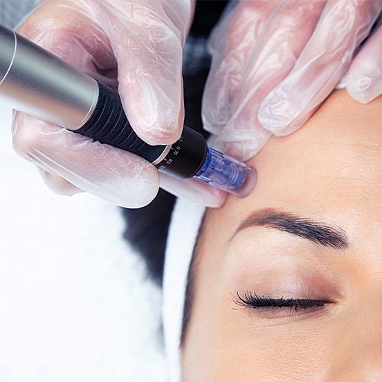 Microneedling procedure on a woman's forehead.