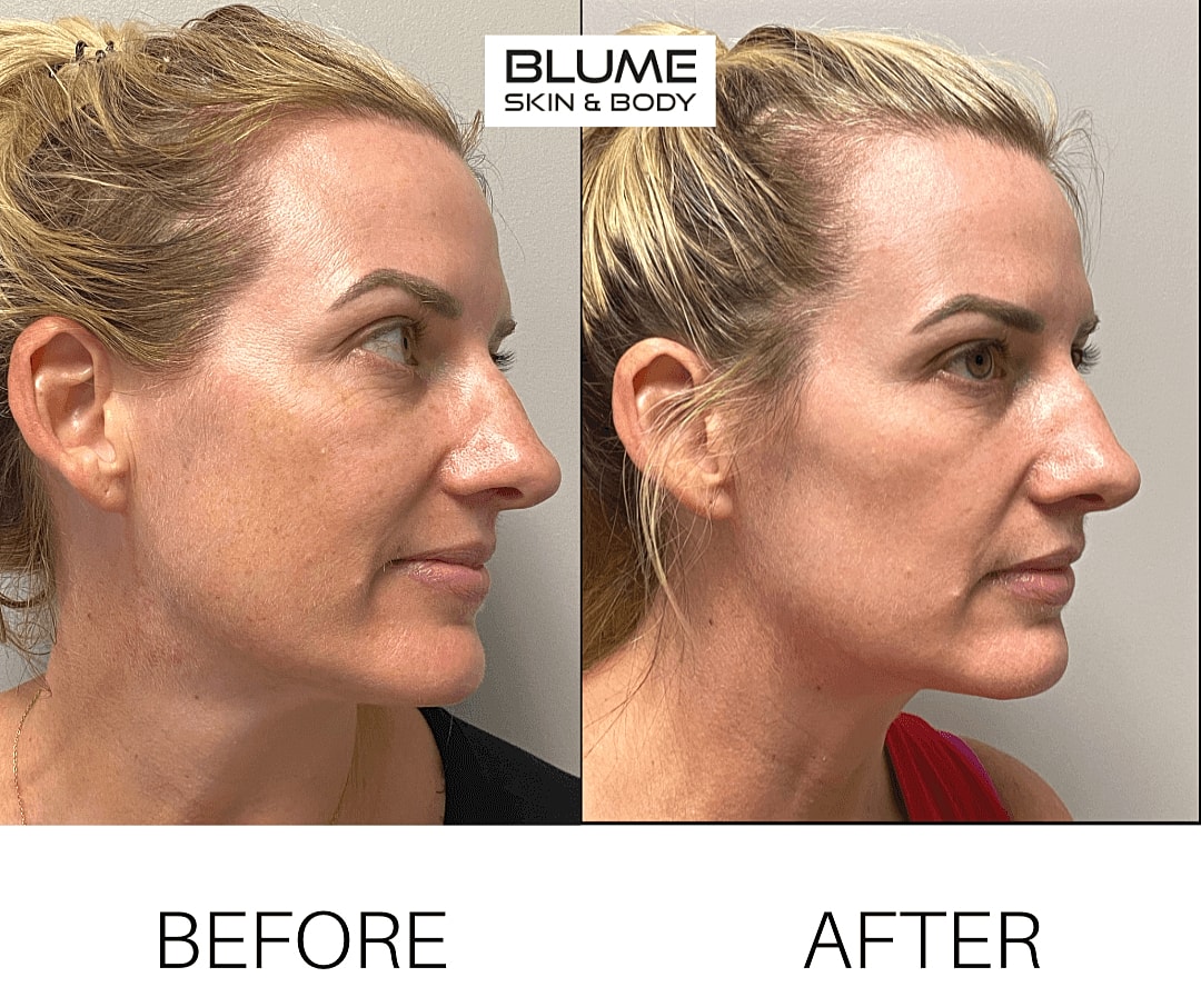 Before and after cosmetic treatment comparison.